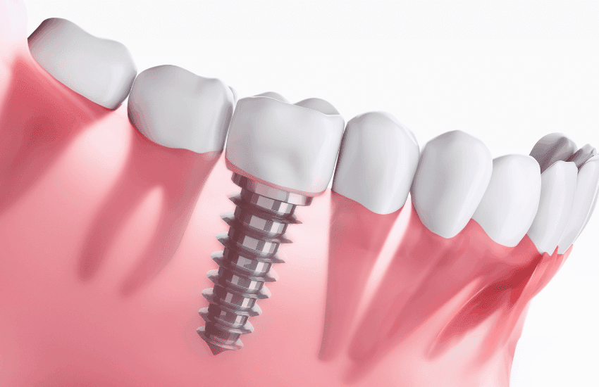 Implantologia – Dentisimo Bielsko-Biała