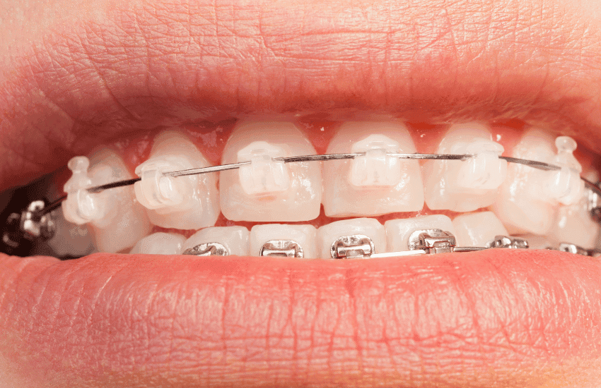 Ortodoncja – Dentisimo Bielsko-Biała